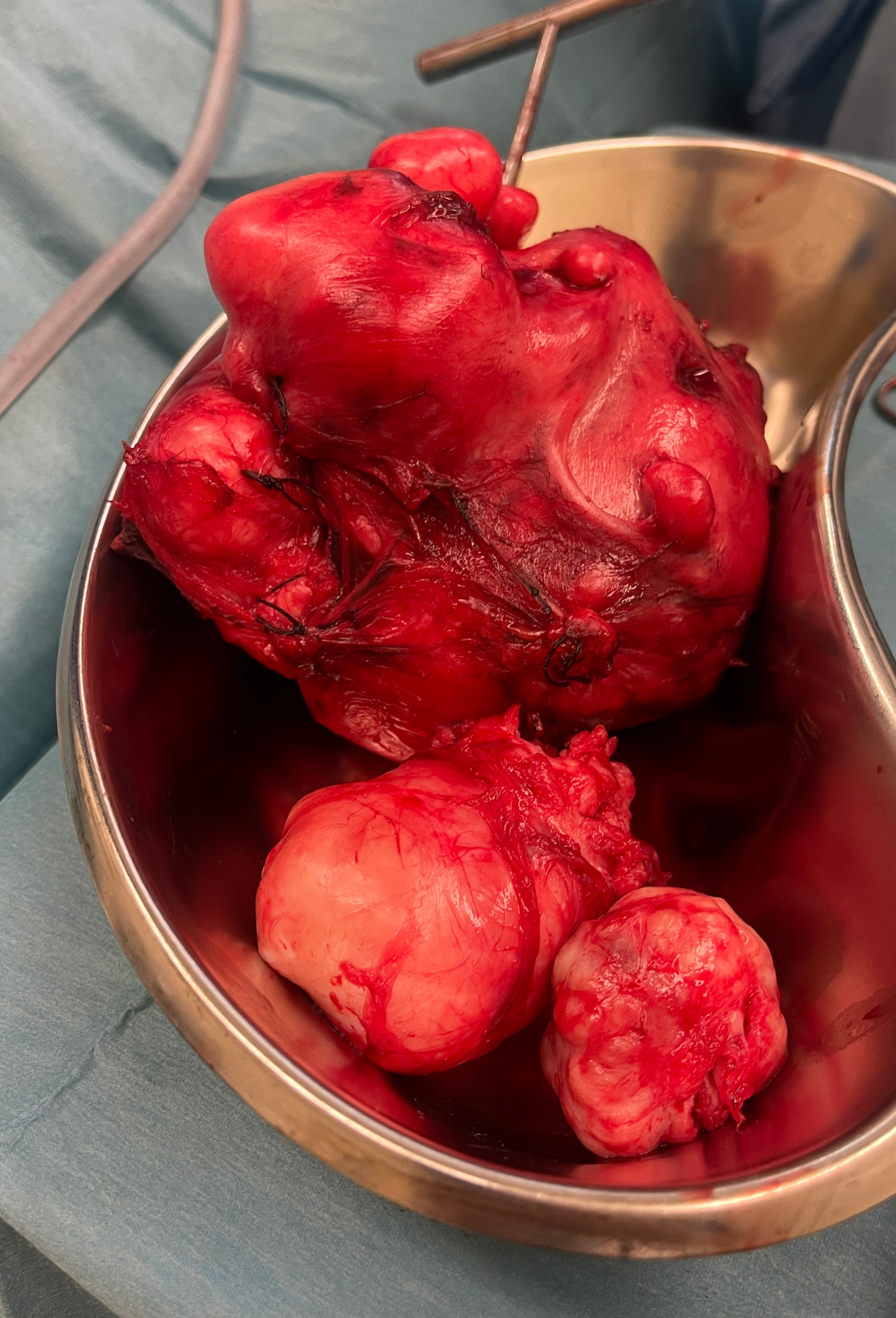 Fibroid